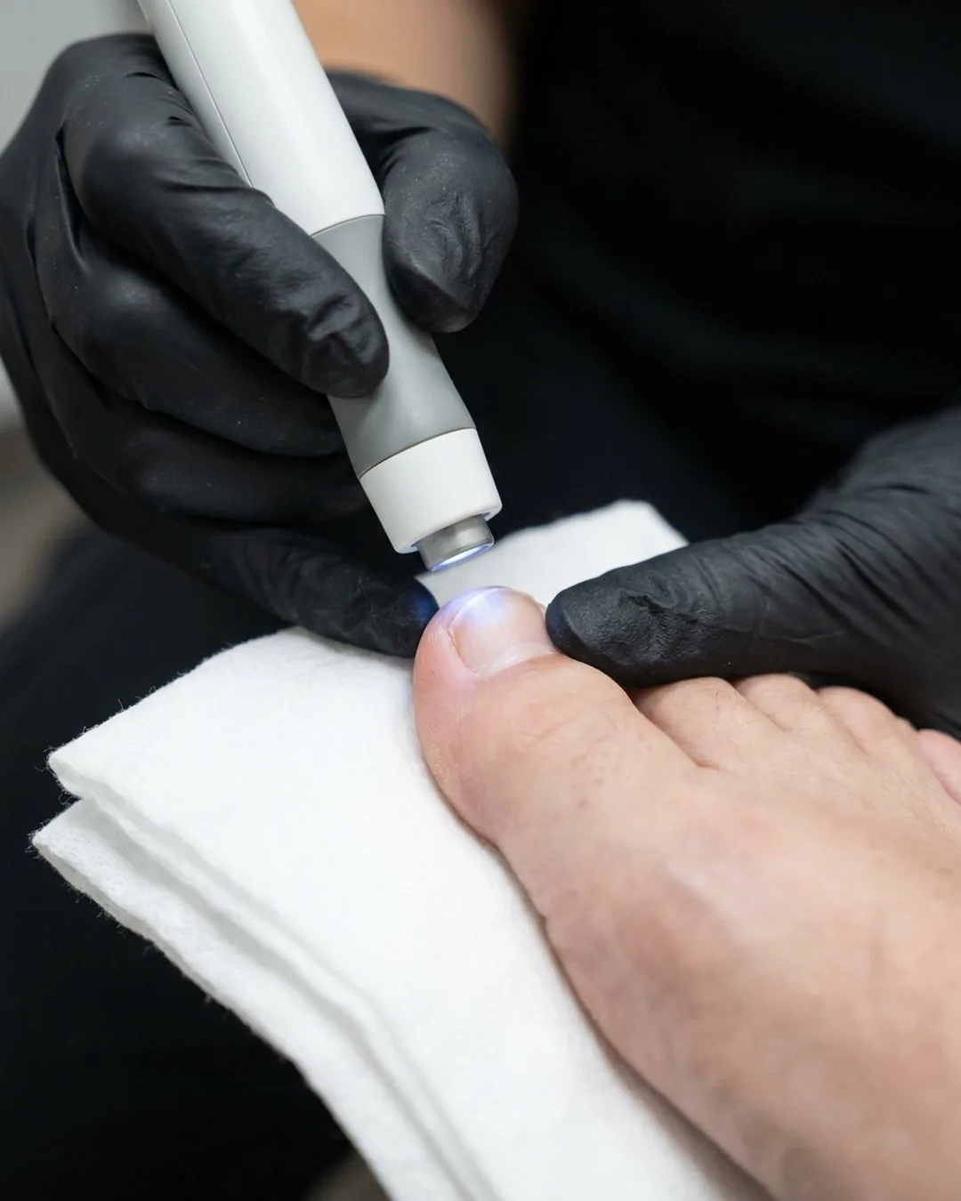 Láser dirigido a la uña del dedo gordo, con el pie seco sobre una toalla