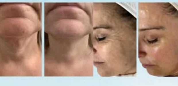 Antes y después de tratamientos HIFU