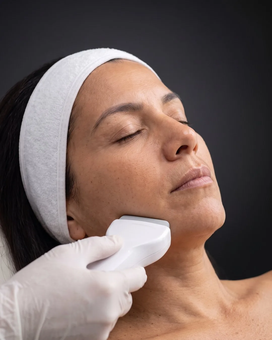 Aplicación de HIFU facial: el cabezal recorre la línea de la mandíbula