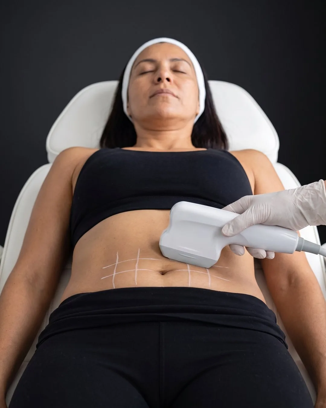 HIFU corporal en abdomen, sobre el trazado de las zonas a tratar