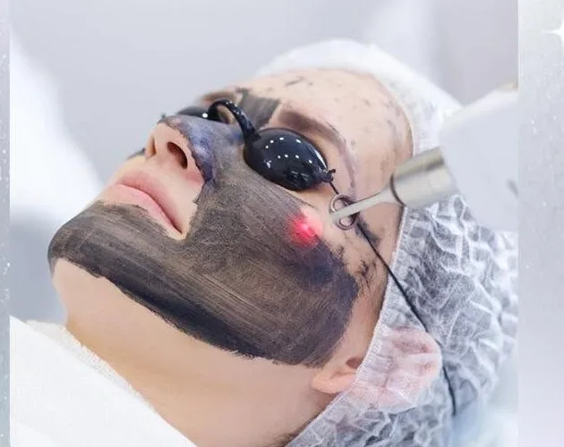 Hollywood Peel con máscara de carbón y láser